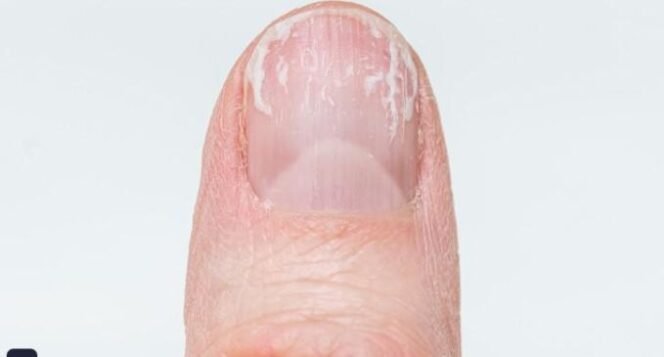 
					Kuku jari seperti ini indikasi penyakit serius