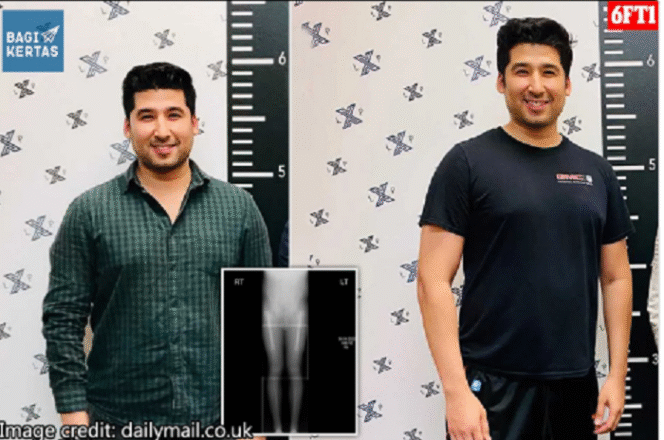 
					Alfonso Flores adalah seorang mahasiswa kedokteran di Texas, Amerika Serikat. Dia rela merogoh koceknya Rp 1 miliar untuk menambah tinggi badannya 5 cm, dari 180 cm menjadi 185 cm. Operasi dilaporkan berjalan baik. Instagram@bagikertas.id