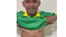pemain bola Pewrseta Tulungagung, Firman Nugraha membuka jerseynya, tampak masih ada beberapa memar di dadanya. Ia  adalah korban   tendangan brutal dari Muhammad Hilmi (Putra Jaya) Pasuruan dalam laga 4 Jatim babak 32 besar melawan Perseta 1970 pada 5 Januari 2026 di Stadion Gelora Bangkalan, Madura. Foto: Instagram@emosijiwakucom
