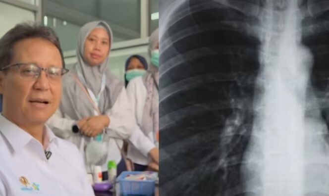 
					Perokok Namun Foto Paru-Paru Tampak Normal, Malah Bisa Berbahaya