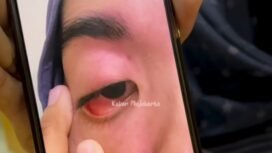 Ludviana Andriana memperlihatkan matanya luka akibat tindakan Inge Marita, saat cekcok soal berlaku lintas. Mereka berdua dipertemukan untuk mediasi perdamaian di Polesta Mojokerto, Minggu, 19 April 2026. Foto: Instagram@ kabar_mojokerto