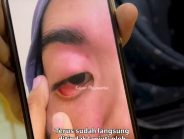 Ludviana Andriana memperlihatkan matanya luka akibat tindakan Inge Marita, saat cekcok soal berlaku lintas. Mereka berdua dipertemukan untuk mediasi perdamaian di Polesta Mojokerto, Minggu, 19 April 2026. Foto: Instagram@ kabar_mojokerto