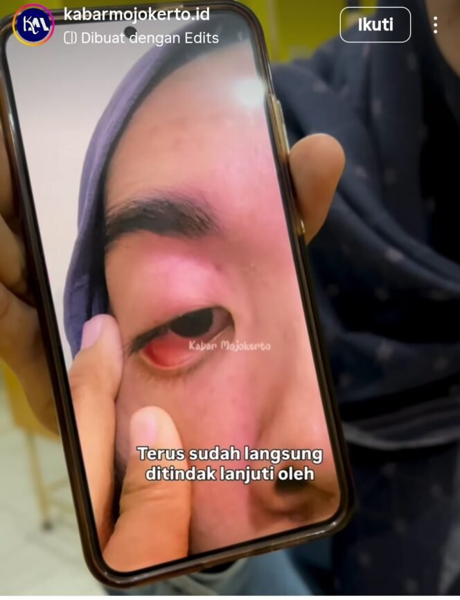 
					Ludviana Andriana memperlihatkan matanya luka akibat tindakan Inge Marita, saat cekcok soal berlaku lintas. Mereka berdua dipertemukan untuk mediasi perdamaian di Polesta Mojokerto, Minggu, 19 April 2026. Foto: Instagram@ kabar_mojokerto